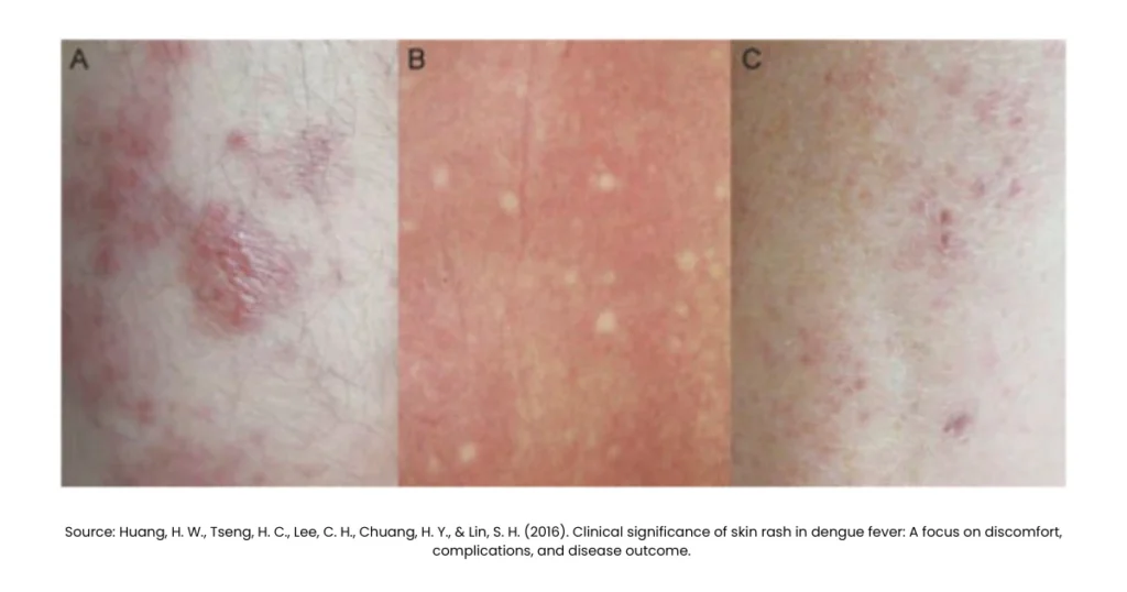 What Are the Symptoms of Dengue Fever: Everything You Need To Know 2 what are the symptoms of dengue fever